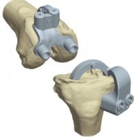 EMPREINTE Knee Prosthesis from Euros