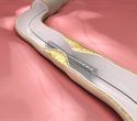Landmark trial shows drug-eluting balloon as effective option for in-stent restenosis