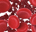 Intravenous iron shows safe and beneficial outcomes for patients with bacterial infection and anemia