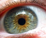 Australian researchers pinpoint specific genetic changes linked to severe AMD