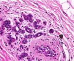Breast Cancer Validation Using Huron Digital Pathology’s TissueScope™