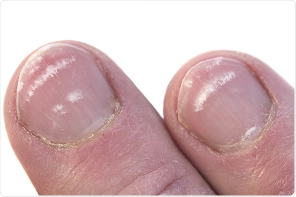 Fingernails closeup with the condition called leukonychia, white lines under the nail. Image Copyright: deepspacedave / Shutterstock