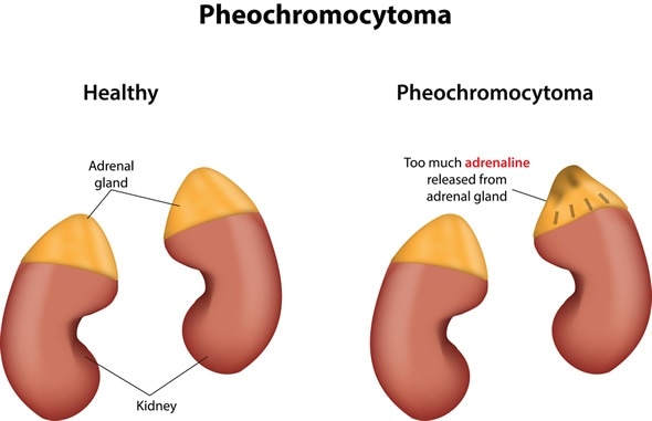 Pheochromocytoma - Image Copyright: joshya / Shutterstock