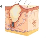 Blackheads and Whiteheads: Overview