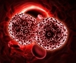 Multiple myeloma rates increasing twice as high in men than in women