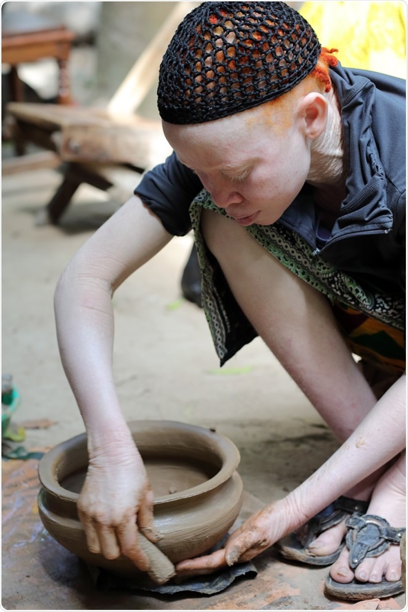 UKEREWE - TANZANIA - JULY 2, 2015: Unidentified albino mother and son on July 2, 2015 in Ukerewe, Tanzania.