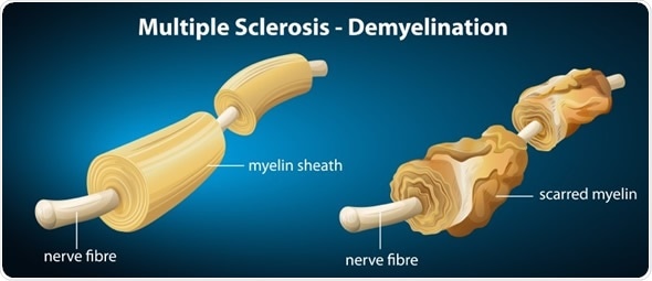 Illustration showing the multiple sclerosis - Image Copyright: BlueRingMedia / Shutterstock