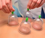 Cupping Therapy / Healing
