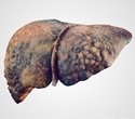 Repurposed drug combination shows strong promise against liver fibrosis