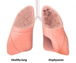 Emphysema detected on CT predicts mortality from all causes