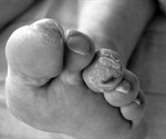 Research: Prognosis for people with diabetic foot ulcers worse than previously thought