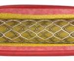 New stenting tool found to be less painful and cheaper than current methods