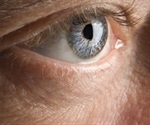 Causes of eye cancer