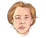 What is Bell's Palsy?