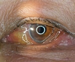 Treating Conjunctivitis
