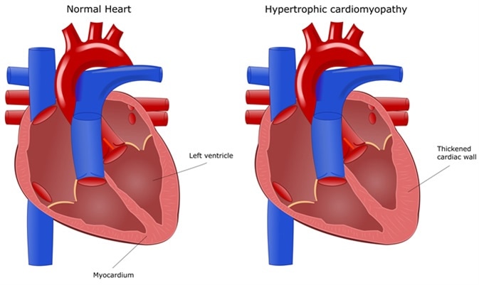 Heart disease: hypertrophic cardiomyopathy. Image Credit: ellepigrafica / Shutterstock