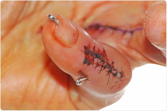 Stainless Steel Pins used to stabilize joints of man