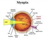 Genetics of Eyesight