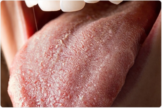 Tongue with Candida albicans infection. Image Credit: sruilk / Shutterstock