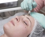 What is Dermabrasion?