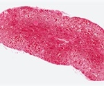 Angiosarcoma Diagnosis