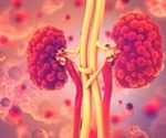 Trial uses water as treatment for polycystic kidney disease