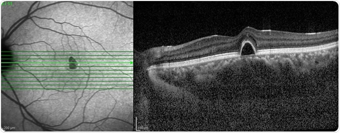 Optical Coherence Tomography (OCT) image of eye in the patient. Image Credit: Chaiwut Siriphithakwong / Shutterstock