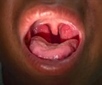 Functions of Tonsils