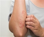 Differentiating Between Eczema and a Rash