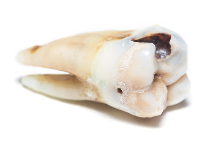 Tooth decay. Image Credit: phichak / Shutterstock