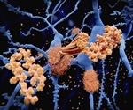 Alzheimer's could possibly be spread via contaminated neurosurgery