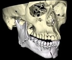What are Mandibular Fractures?