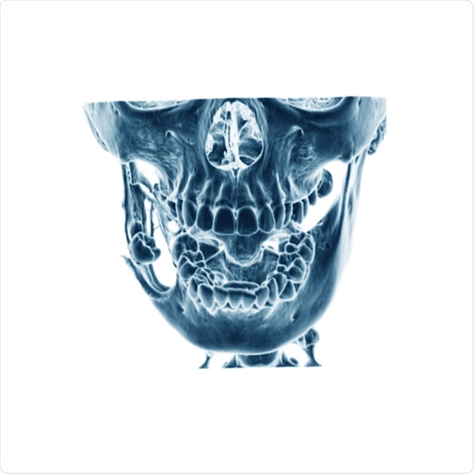 Ct scan (computed tomography) of dental mandible, case of keratocystic odontogenic tumor (right side). Image Credit: Suttha Burawonk / Shutterstock