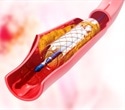 Sirolimus-eluting balloon emerges as a safe and effective option for coronary in-stent restenosis