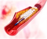Sirolimus-eluting balloon emerges as a safe and effective option for coronary in-stent restenosis
