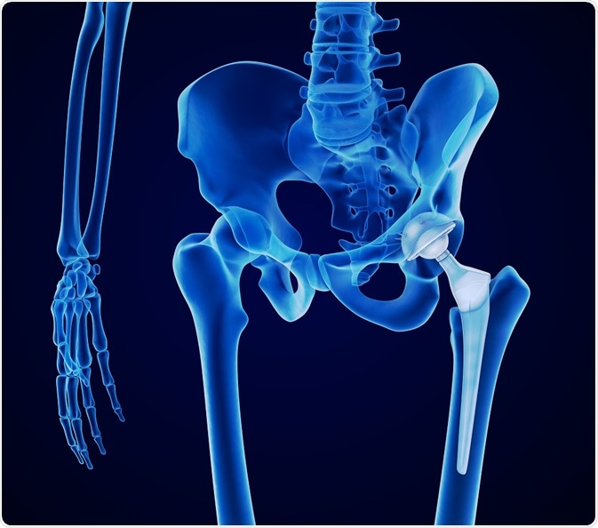 Vector image hip replacement
