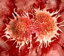 Durvalumab extends survival in small cell lung cancer but raises cost concerns