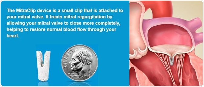 Image Credit: http://mitraclip.com