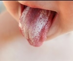 Oral Thrush in Adults