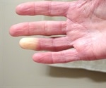 What is Raynaud's Syndrome?