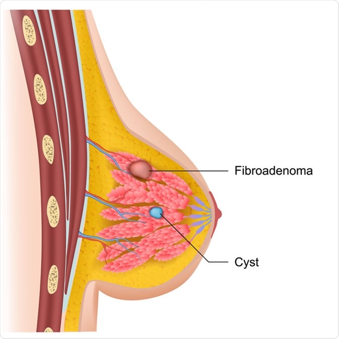 Breast cysts and fibroadenoma medical illustration. Credit: medicalstocks / Shutterstock