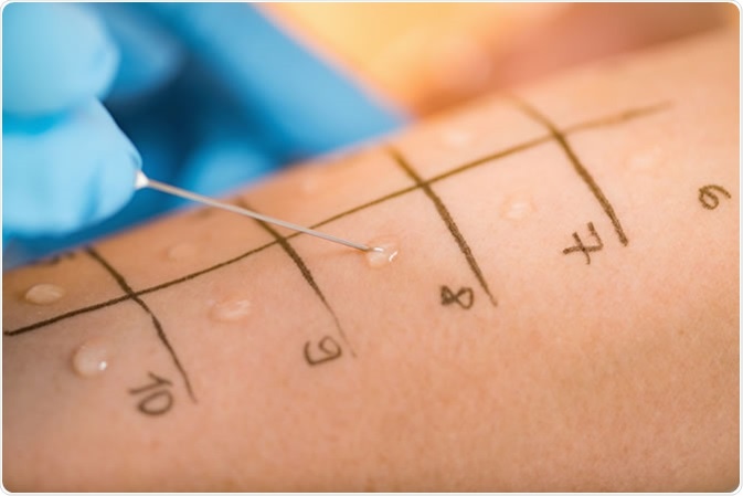 Skin prick allergy test. Image Credit: Microgen / Shutterstock