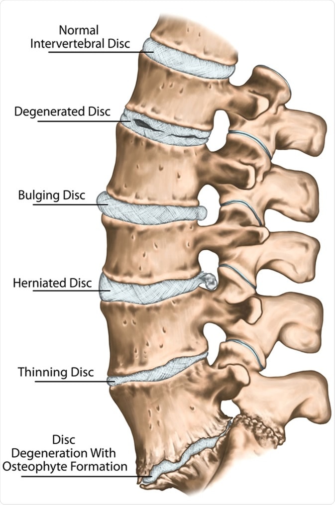 Spine disc problems, degenerative lumbar disc disease, degenerative disc disorder, degenerated disk, bulging disk, herniated disk, thinning disk, disk degeneration with osteophyte formation - Image Credit: Stihii / Shutterstock