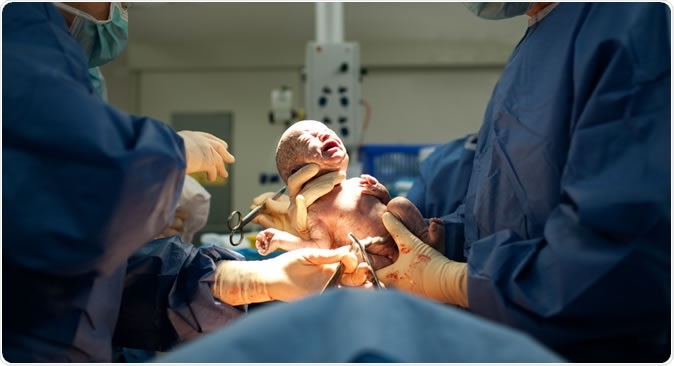 Baby being born via Caesarean Section. Credit: Martin Valigursky / Shutterstock