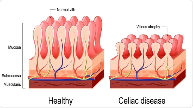 Celiac disease. Normal villi and villous atrophy. Image Credit: Designua / Shutterstock