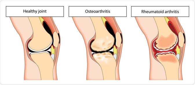osteoarthritis rheumatoid arthritis