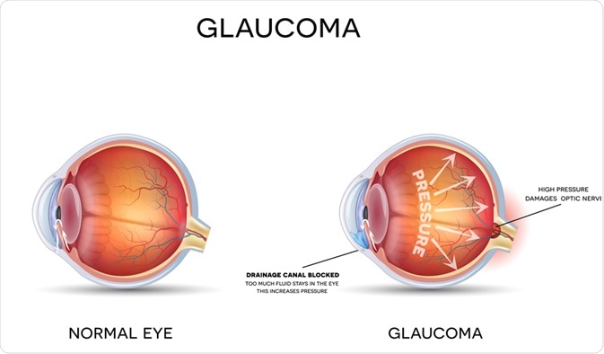 Health eye versus eye with glaucoma