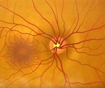 What is Normal-Tension Glaucoma?
