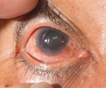 What is Traumatic Glaucoma?