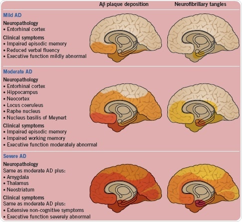The neuropathology and clinical symptoms shown as Alzheimer